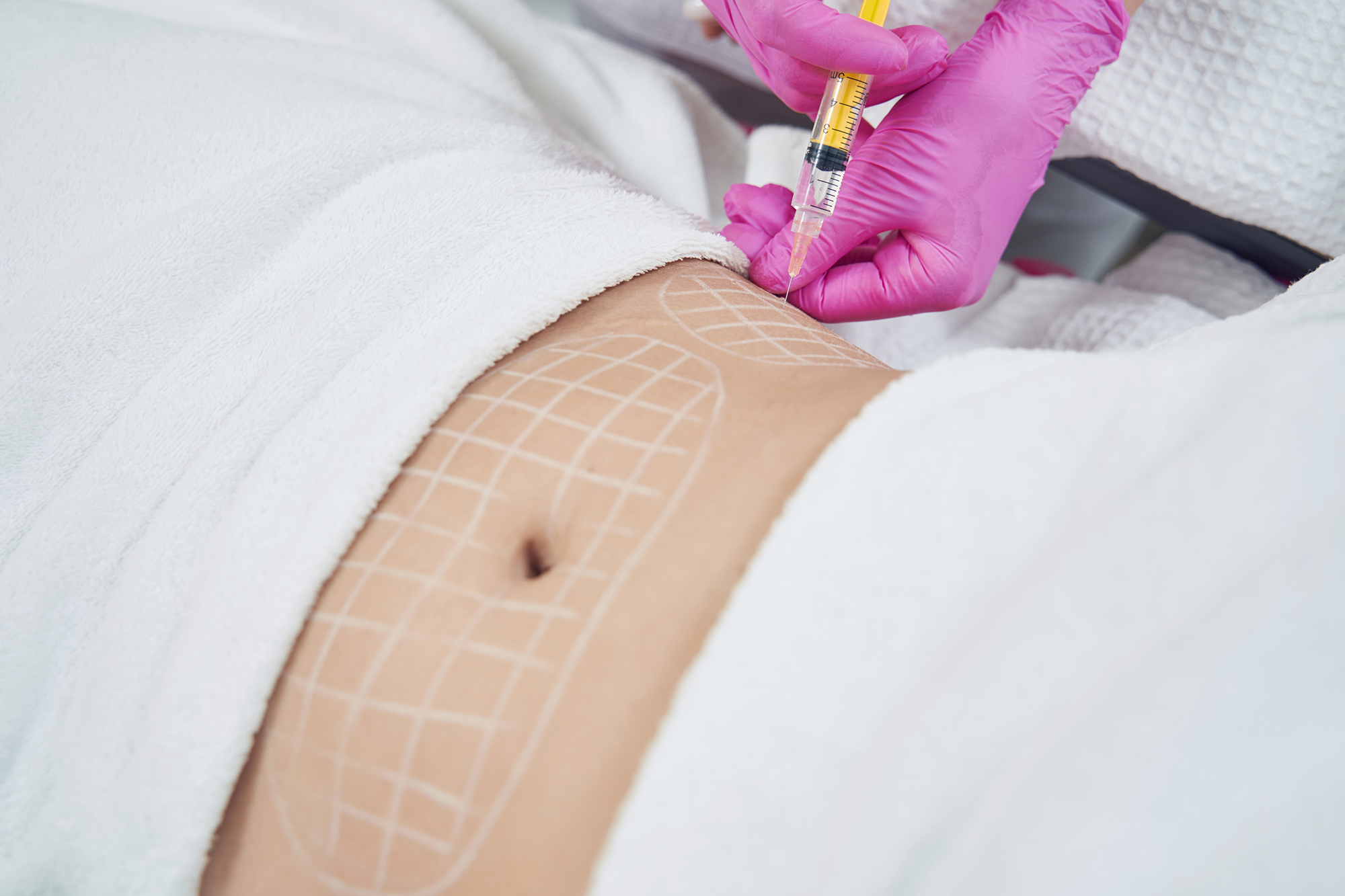 Fat Dissolving Treatments